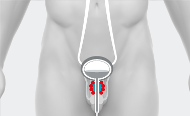 Ipertrofia prostatica benigna