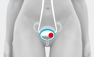 Tumore della vescica