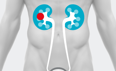 Tumore maligno del rene