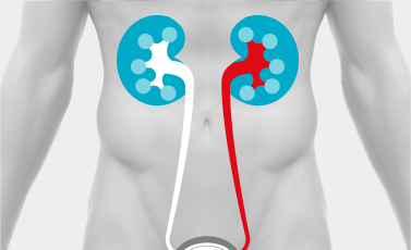 Tumore delle alte vie urinarie