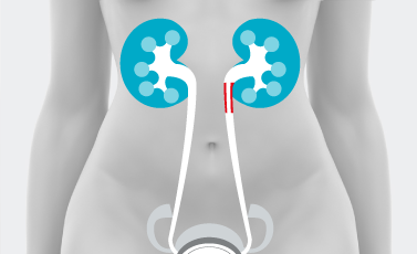 Stenosi del giunto pielo ureterale