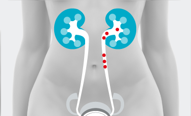 Calcolosi reno ureterale