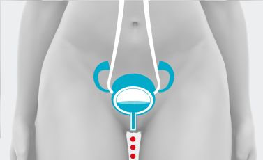 Incontinenza urinaria